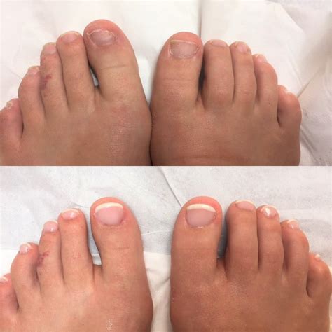 wilde pedique toenail reconstruction.